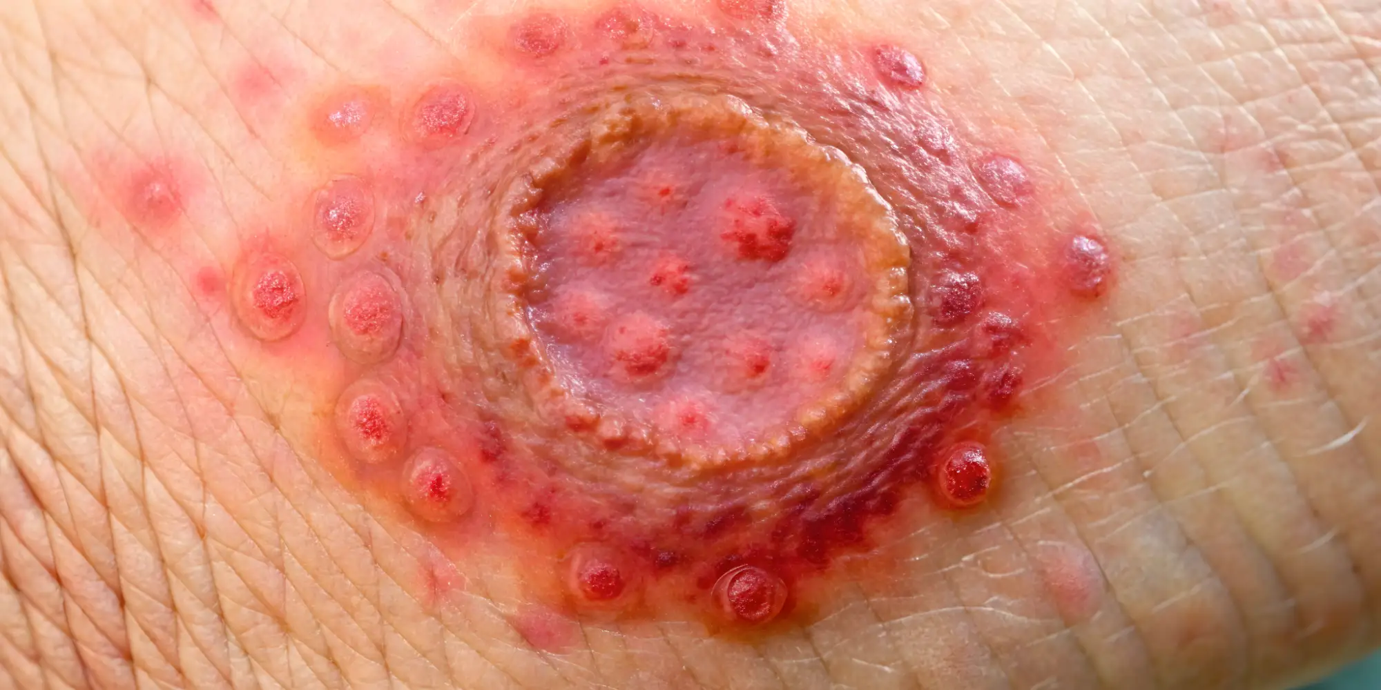 Cysts & Benign Tissue Swellings Clinical Protocol